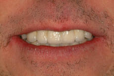 with temporary teeth