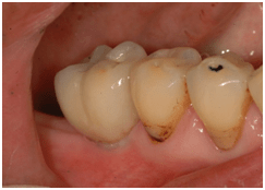 Dental Implant