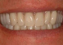 Full Upper and Lower Titanium Acrylic Bridges on Implants