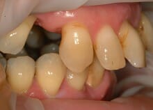 Full Upper Implant Bridge