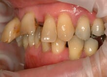 Full Upper Implant Bridge