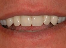 Full Upper and Lower Titanium Acrylic Bridges on Implants