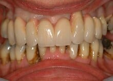 Full Upper Implant Bridge