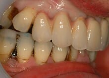 Full Upper Implant Bridge