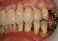 Full Upper Implant Bridge