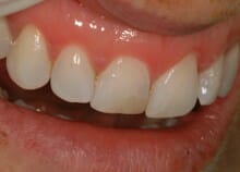 Immediate Veneers - Single Upper Incisor