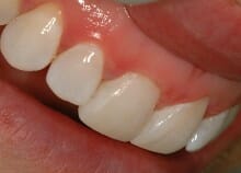 Immediate Veneers - Single Upper Incisor