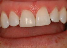 Immediate Veneers - Single Upper Incisor