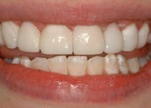 Immediate Veneers - Upper Front Teeth