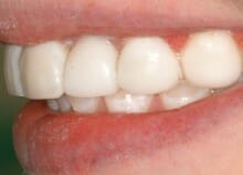 Immediate Veneers - Upper Front Teeth