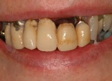 Implant Retained Dentures