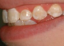 Immediate Veneers - Upper Front Teeth