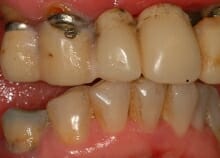 Implant Retained Dentures