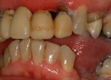 Implant Retained Dentures