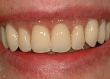 Implant Retained Dentures