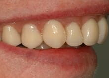 Implant Retained Dentures