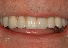 Full Upper Ceramic Implant Bridge