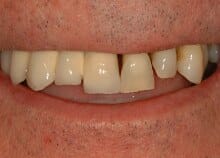 Full Upper Ceramic Implant Bridge