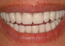 Upper and Lower Implant retained dentures