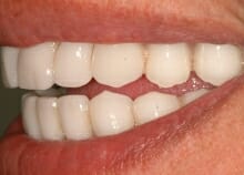 Upper and Lower Implant retained dentures