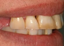 Upper and Lower Implant retained dentures