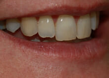 Inman Aligner