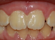 early orthodontics - teeth straightening for children in essex after