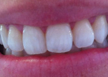 Cosmetic Teeth Whitening