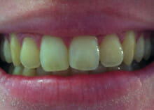 Cosmetic Teeth Whitening before