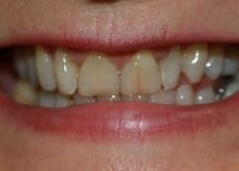 teeth whitening before and after photos