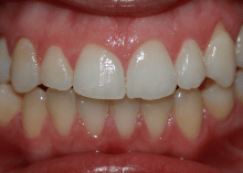 complex invisalign study