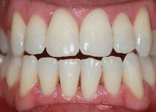 Invisalign Lite for Crowding