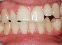 A complex invisalign case