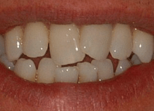 Invisalign Lite for Crowding