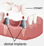 Fixed Partial Denture