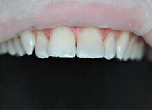 case-1-immediate-veneer-micro-invasive-before and after