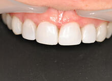 case-2-immediate-veneers-after