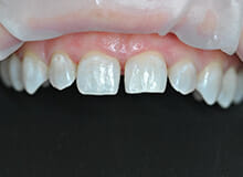 case-2-immediate-veneers-before