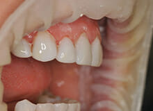 case-3-immediate-veneers-after-2