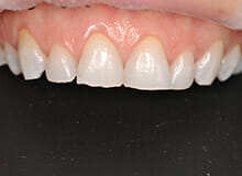 case-3-immediate-veneers-after-3