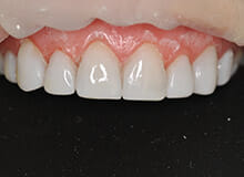 case-3-immediate-veneers-after