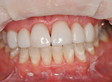 case-4-immediate-veneers-after