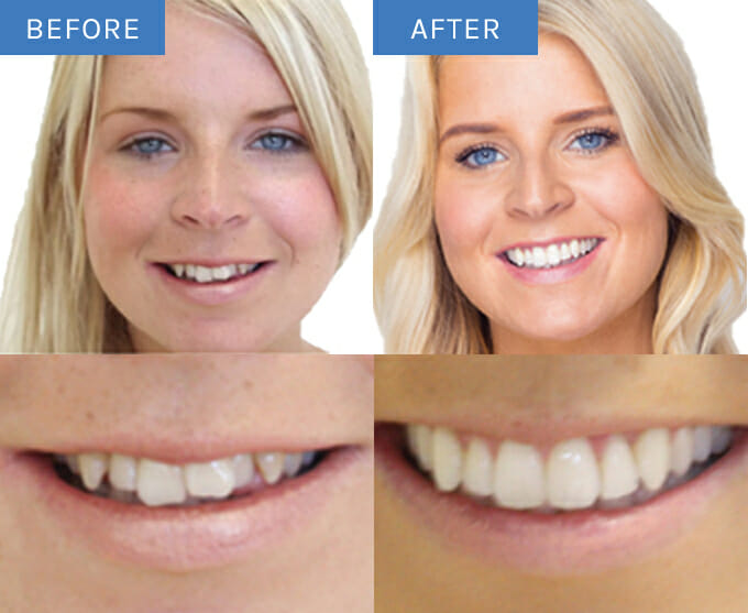 ws-a-brand-new-smile-before-after-680x557