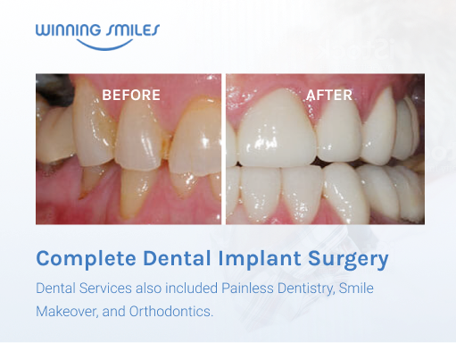 Dental Implants Before and After