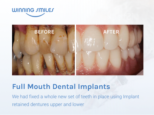 Dental Implants Before and After