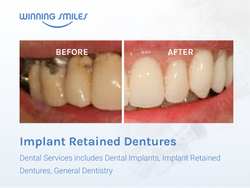 Dental Implants Before and After