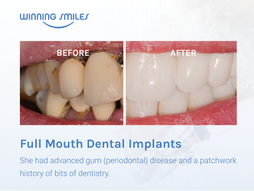 Dental Implants Before and After